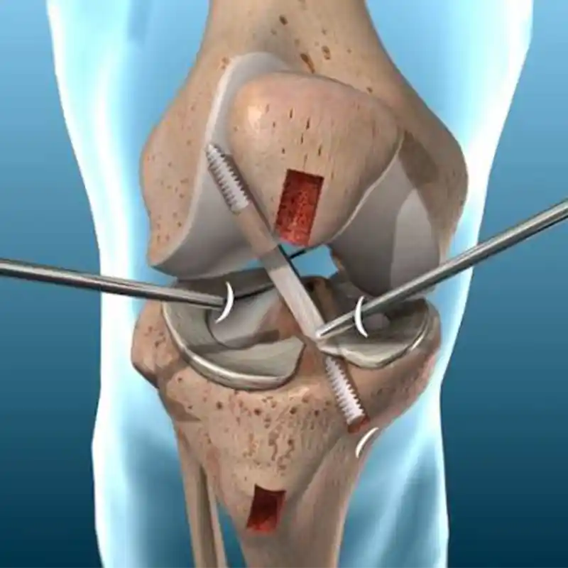 artroscopia-de-rodilla-dr-christian-rodriguez