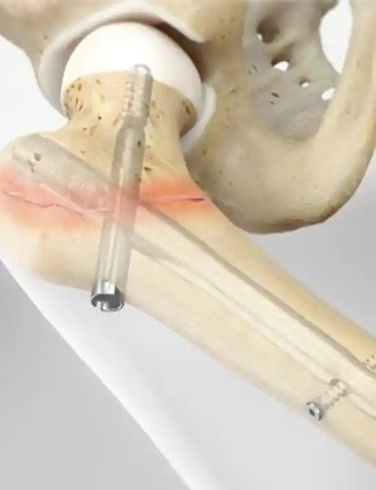 osteosintesis-cirugía-de-cadera-dr-rodriguez